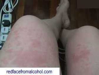 Red flushing reaction on thighs.