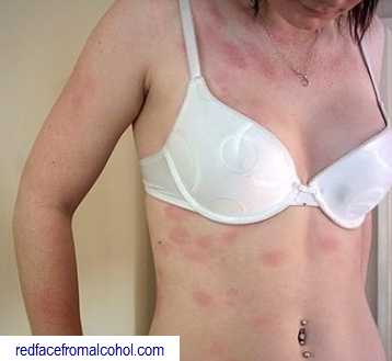 Asian flushing red bumps and hives on torso of woman.