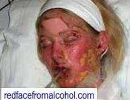 Extremely severe reaction to alcohol.