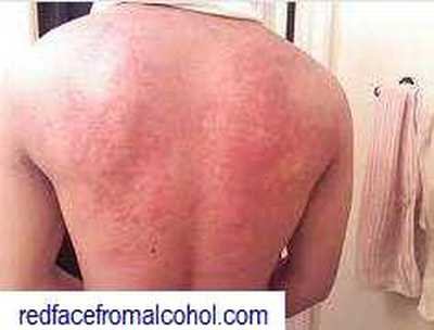 Red blotches and bumps on the back of alcohol allergy sufferer.